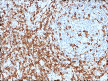 CD5 Antibody Clone CD5/2418. Immunohistochemistry analysis of CD5 antibody staining in FFPE human tonsil tissue using a microarray specificity validated antibody. Strong membranous staining is observed in T lymphocytes within interfollicular regions, with dense labeling surrounding germinal centers while follicular B cell areas remain largely negative. The staining pattern highlights normal tonsillar architecture and supports selective detection of CD5-positive T cell populations, consistent with microarray specificity validation. Heat-induced epitope retrieval was performed in 10 mM citrate buffer, pH 6, for 10-20 minutes followed by cooling at room temperature prior to antibody incubation.