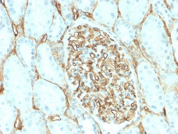 CD34 Antibody Renal Cell Carcinoma IHC. Immunohistochemistry testing of FFPE human renal cell carcinoma with recombinant CD34 antibody (clone HPCA1/2598R). Required HIER: boil tissue sections in 10mM Tris with 1mM EDTA, pH 9, for 10-20 min followed by cooling at RT for 20 min.