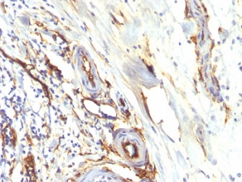 CD34 Antibody Colon Carcinoma IHC. Immunohistochemistry testing of FFPE human colon carcinoma with recombinant CD34 antibody (clone HPCA1/2598R). Required HIER: boil tissue sections in 10mM Tris with 1mM EDTA, pH 9, for 10-20 min followed by cooling at RT for 20 min.