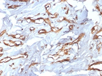 CD34 Antibody Angiosarcoma IHC. Immunohistochemistry testing of FFPE human angiosarcoma with recombinant CD34 antibody (clone HPCA1/2598R). Required HIER: boil tissue sections in 10mM Tris with 1mM EDTA, pH 9, for 10-20 min followed by cooling at RT for 20 min.