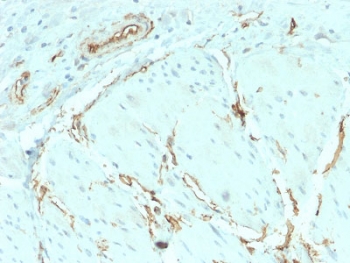 CD34 Antibody Breast Cancer IHC. Immunohistochemistry testing of FFPE human breast carcinoma with recombinant CD34 antibody (clone HPCA1/2598R). Required HIER: boil tissue sections in 10mM Tris with 1mM EDTA, pH 9, for 10-20 min followed by cooling at RT for 20 min.