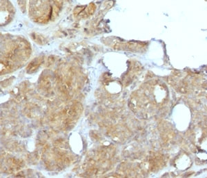 MVP Antibody for IHC. Immunohistochemistry analysis of Major Vault Protein (MVP / LRP) expression in FFPE human breast carcinoma using clone MJVP-1R mouse monoclonal antibody. Tumor epithelial cells exhibit moderate to strong cytoplasmic HRP-DAB brown staining with a diffuse to granular pattern, consistent with intracellular vault complex localization, while surrounding stromal elements show lower background signal. The staining highlights malignant cell populations within tumor nests, supporting the association of Major vault protein with tumor cell survival and drug resistance-related cellular stress pathways. Heat-induced epitope retrieval was performed in pH 9 10mM Tris with 1mM EDTA for 10-20 minutes followed by cooling prior to antibody incubation.