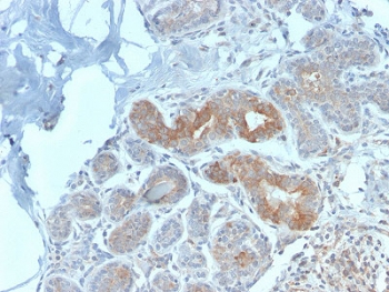 MVP Antibody Breast Carcinoma IHC. Immunohistochemistry analysis of Major Vault Protein (MVP / LRP) expression in FFPE human breast carcinoma using clone VP2897R rabbit monoclonal antibody. Tumor epithelial cells exhibit moderate cytoplasmic HRP-DAB brown staining with a diffuse to finely granular pattern, consistent with vault complex structural localization, while surrounding stromal regions show comparatively lower signal. The staining highlights gland-forming tumor structures and cellular architecture, supporting the role of Major vault protein as a core structural component of vault particles within malignant epithelial cells. Heat-induced epitope retrieval was performed in pH 9 10mM Tris with 1mM EDTA for 10-20 minutes followed by cooling prior to antibody incubation.