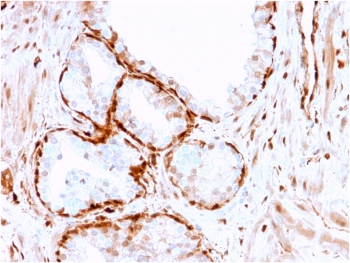 Aldose Reductase Antibody Prostate Cancer IHC. Immunohistochemistry analysis of FFPE human prostate cancer tissue stained with Aldose reductase antibody clone CPTC-AKR1B1-3. Strong cytoplasmic HRP-DAB brown staining is observed within prostate tumor epithelial cells, consistent with the expected intracellular localization of Aldose reductase / AKR1B1, a polyol pathway-associated metabolic enzyme involved in glucose metabolism and oxidative stress-responsive signaling pathways. Tissue sections underwent HIER using 10mM citrate buffer, pH 6, prior to immunostaining.