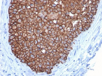 Immunohistochemistry analysis of FFPE human breast carcinoma tissue using protein microarray validated HER2 antibody (clone ERBB2/3092). Brown chromogenic signal indicates HER2-positive membranous staining in tumor epithelial cells. Heat-induced epitope retrieval was performed by boiling tissue sections in pH 6 10mM citrate buffer for 10-20 minutes, followed by cooling at room temperature prior to antibody incubation.