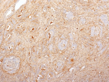 Fibronectin Antibody Prostate Carcinoma Immunohistochemistry. IHC staining of FFPE human prostate carcinoma with Fibronectin antibody (clone 616). HIER: boil tissue sections in 10mM Tris with 1mM EDTA, pH 9, for 10-20 min followed by cooling prior to testing.