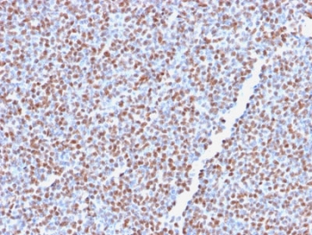 ALK Antibody Recombinant ALCL IHC. Immunohistochemistry staining of FFPE human anaplastic large-cell lymphoma tissue using recombinant monoclonal clone ALK1/2766R demonstrates diffuse nuclear and cytoplasmic HRP-DAB brown staining across malignant lymphoid cell populations, consistent with expression of oncogenic ALK fusion-associated protein in ALK-positive lymphoma. The staining pattern reinforces the established association between ALK rearrangement-driven kinase signaling and anaplastic large-cell lymphoma pathobiology. HIER: boil tissue sections in 10mM Tris buffer with 1mM EDTA, pH 9, for 10-20 min followed by cooling at room temperature for 20 min.