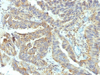 ALPL Antibody Ovaria Carcinoma IHC. Immunohistochemistry testing of FFPE human ovarian carcinoma with ALPL antibody (clone V17.1). Required HIER: boil tissue sections in 10mM Tris with 1mM EDTA, pH 9, for 10-20 min followed by cooling at RT for 20 min.