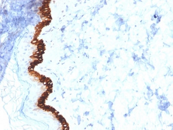 IHC testing of FFPE human basal cell carcinoma with Cytokeratin 15 antibody (clone KRT15/2554). Required HIER: boil tissue sections in 10mM citrate buffer, pH 6, for 10-20 min.