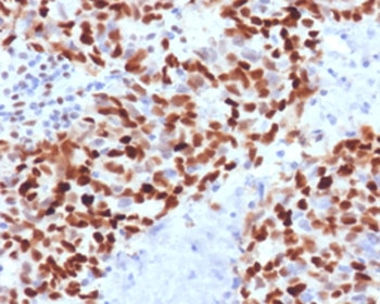 Immunohistochemistry analysis of MSH6 antibody in human colon carcinoma tissue. MSH6 Antibody Mouse Monoclonal MTS6-1 was used for immunohistochemistry on FFPE human colon carcinoma tissue. Prominent HRP-DAB brown nuclear staining is observed in malignant epithelial cells, consistent with the nuclear localization of MutS homolog 6 (MSH6), a DNA mismatch repair protein that recognizes replication-associated base mismatches. Tumor cell nuclei show strong positive labeling across gland-forming carcinoma regions, while surrounding stromal cells demonstrate comparatively weaker staining. Heat-induced epitope retrieval was performed by boiling tissue sections in pH 9 10mM Tris with 1mM EDTA for 10-20 min followed by cooling prior to immunostaining.