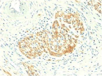 IHC staining of FFPE human colon carcinoma with CD56 antibody (clone NCAM1/2217R). HIER: boil tissue sections in pH6, 10mM citrate buffer, for 10-20 min followed by cooling at RT for 20 min.