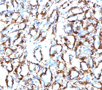 IHC testing of FFPE human angiosarcoma with recombinant CD34 antibody (clone CDLA34-2R). Required HIER: boil tissue sections in 10mM Tris with 1mM EDTA, pH 9, for 10-20 min followed by cooling at RT for 20 min.