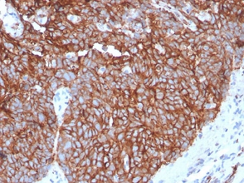 GLUT1 Antibody Recombinant Rabbit MAb GLUT1/3132R. Immunohistochemistry analysis of GLUT1 / SLC2A1 in FFPE human tongue tissue shows strong HRP-DAB brown membranous staining in epithelial cells, consistent with the plasma membrane localization of the GLUT1 glucose transporter. The staining outlines the borders of stratified epithelial cells and highlights the characteristic membrane-associated distribution of GLUT1 in metabolically active epithelial tissue. Stromal and connective tissue components show minimal staining, providing contrast to the epithelial signal. Heat induced epitope retrieval was performed by boiling tissue sections in pH 9 10mM Tris buffer with 1mM EDTA for 10-20 minutes followed by cooling at room temperature prior to antibody incubation.