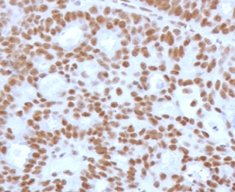 TLE1 Antibody / Synovial Sarcoma Marker immunohistochemistry analysis of human endometrial carcinoma using clone TLEP1-2R. Formalin-fixed paraffin-embedded human endometrial carcinoma tissue shows strong nuclear staining in tumor cells consistent with expression of Transducin-Like Enhancer Protein 1, a transcriptional corepressor widely studied as a synovial sarcoma marker in tumor pathology. Nuclear staining highlights malignant epithelial cells while surrounding stromal components show weaker or absent staining. Although TLE1 is most frequently discussed as a synovial sarcoma marker due to its consistent nuclear expression in synovial sarcoma tumors, TLE1 expression can also be observed in other tumor types including certain epithelial malignancies. Heat-induced epitope retrieval was performed by boiling tissue sections in pH 9 Tris-EDTA buffer for 10-20 minutes followed by cooling prior to antibody staining.