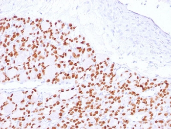PAX8 Antibody / Thyroid Differentiation Marker Antibody immunohistochemistry in human thyroid tissue showing strong nuclear HRP-DAB brown staining in follicular epithelial cells. Paired box protein Pax-8 (PAX8) expression is localized to nuclei of thyroid follicular cells lining colloid-filled follicles, with clear sparing of colloid material and surrounding stromal tissue. The staining pattern highlights dense follicular epithelial populations with expected nuclear positivity, while non-epithelial cells remain negative with hematoxylin-only nuclear counterstain. This distinct nuclear localization supports the role of PAX8 as a thyroid lineage transcription factor and reinforces its utility as a differentiation marker in thyroid tissue analysis. Heat-induced epitope retrieval was performed by boiling tissue sections in 10mM Tris buffer with 1mM EDTA, pH 9, for 10-20 minutes followed by cooling prior to antibody incubation.