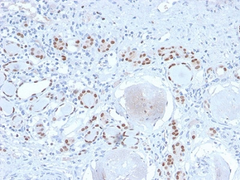 PAX8 Antibody / Thyroid Differentiation Marker Antibody immunohistochemistry in human kidney tissue showing nuclear HRP-DAB brown staining in renal tubular epithelial cells. Paired box protein Pax-8 (PAX8) expression is localized to nuclei of tubular epithelial cells, with clear staining of nephron structures and minimal signal in surrounding stromal components. The presence of nuclear positivity in kidney tissue reflects shared epithelial lineage expression of PAX8 and highlights the importance of tissue context when interpreting thyroid differentiation markers. Background cells remain largely negative with hematoxylin-only nuclear staining. Required HIER: boil tissue sections in 10mM Tris buffer with 1mM EDTA, pH 9, for 10-20 min and allow to cool before testing.