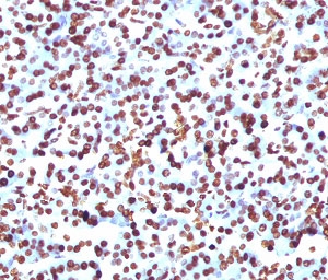 SOX9 Antibody Pancreas Tumor Progression IHC. Immunohistochemistry analysis of FFPE human pancreas using SOX9 Antibody. Mouse monoclonal antibody clone SRYB9-1 demonstrates strong nuclear HRP-DAB brown staining in epithelial cell populations, consistent with SOX9 expression in proliferative and tumor progression-associated compartments. Staining highlights clusters of cells with increased nuclear signal, while surrounding stromal elements show minimal reactivity, providing clear contrast. The observed pattern supports SOX9 as a tumor progression marker in pancreatic tissue. Heat-induced epitope retrieval was performed using pH 9 Tris-EDTA buffer to optimize nuclear antigen detection.