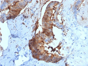 Cathepsin D Antibody Renal Cell Carcinoma Immunohistochemistry. IHC testing of FFPE human renal cell carcinoma with Cathepsin D antibody (clone CTSD/2781). HIER: boil tissue sections in pH6, 10mM citrate buffer, for 10-20 min followed by cooling at RT for 20 min.