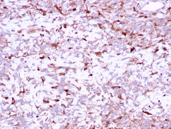 Cathepsin K Lysosomal Protease Antibody Liver Parenchyma IHC. Immunohistochemistry analysis of FFPE human liver tissue using Cathepsin K Antibody (clone CTSK/2791) shows scattered granular cytoplasmic staining in discrete cell populations within the hepatic parenchyma, consistent with CTSK / Cathepsin K localization in lysosomal compartments. The punctate pattern reflects localized protease activity associated with tissue remodeling, while hepatocytes display comparatively low background staining. Hematoxylin counterstain provides nuclear contrast and structural detail. HIER: boil FFPE tissue sections in pH 6, 10 mM citrate buffer, for 10-20 min followed by cooling at RT for 20 min.