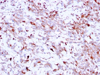 Cathepsin K Lysosomal Protease Antibody Hepatic Stromal Region IHC. Immunohistochemistry analysis of FFPE human liver tissue using Cathepsin K Antibody (clone CTSK/2791) shows granular cytoplasmic staining in scattered stromal and sinusoidal-associated cells, consistent with CTSK / Cathepsin K localization in lysosomal compartments. The punctate staining pattern reflects localized protease activity linked to tissue remodeling, while adjacent hepatocytes exhibit relatively low background signal. Hematoxylin counterstain provides nuclear contrast and architectural context. HIER: boil FFPE tissue sections in pH 6, 10 mM citrate buffer, for 10-20 min followed by cooling at RT for 20 min.