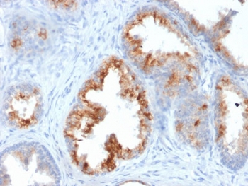 AMACR Antibody Prostate Carcinoma IHC. Immunohistochemistry staining of FFPE human prostate carcinoma tissue using clone AMACR/1864 demonstrates granular cytoplasmic HRP-DAB brown staining in malignant prostatic epithelial cells, consistent with the characteristic expression pattern of AMACR / p504S in prostate adenocarcinoma. Required HIER: steam section in pH6 citrate buffer for 20 min and allow to cool prior to staining.