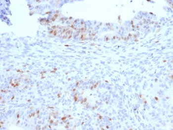 RAD51 Antibody Colon Carcinoma IHC. Immunohistochemical staining of FFPE human colon carcinoma demonstrates RAD51 expression using a RAD51 antibody. RAD51, also known as a Homologous Recombination Protein, is a key mediator of DNA double strand break repair and maintenance of genomic stability. Predominantly nuclear staining is observed in neoplastic cells, consistent with the elevated DNA repair activity frequently associated with proliferating tumors. Heat induced epitope retrieval was performed by boiling tissue sections in pH 9 10 mM Tris buffer containing 1 mM EDTA for 10 to 20 minutes followed by cooling prior to staining. These results support the utility of RAD51 Antibody for investigating homologous recombination, DNA damage responses, and therapeutic resistance in human cancers.
