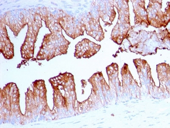 FOLH1 Antibody Prostate Cancer IHC. Immunohistochemistry analysis of FFPE human prostate carcinoma tissue stained with FOLH1 Antibody / Prostate Cancer and PSMA Marker. Tumor epithelial cells display strong membranous and cytoplasmic HRP-DAB brown staining consistent with expression of Folate hydrolase 1 / FOLH1, also known as Prostate-specific membrane antigen / PSMA, a membrane-associated glycoprotein widely studied in prostate tumor biology and epithelial differentiation pathways. Required HIER: boil tissue sections in pH 9 10mM Tris with 1mM EDTA for 10-20 min and allow to cool before testing.