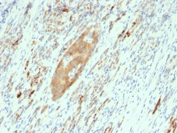 GAD65 Antibody Pancreas IHC. Immunohistochemistry analysis of FFPE human pancreas tissue stained with GAD65 Antibody demonstrates cytoplasmic HRP-DAB brown staining within scattered islet-associated endocrine cell populations, consistent with Glutamate decarboxylase 65 / GAD2 expression in inhibitory neurotransmitter-associated secretory cells. This synaptic GABA marker antibody highlights GABA synthesis-associated signaling pathways and neuroendocrine regulatory biology within pancreatic tissue. Required HIER: boil tissue sections in 10mM citrate buffer, pH 6, for 10-20 min and allow to cool prior to testing.