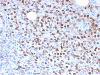 IHC staining of FFPE human melanoma with recombinant MITF antibody (clone MITF/2987R). HIER: boil tissue sections in pH 9 10mM Tris with 1mM EDTA for 10-20 min and allow to cool before testing.