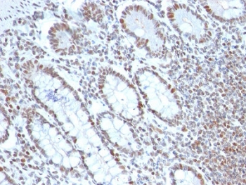 BMI-1 Antibody Colon Cancer IHC. Immunohistochemistry testing of FFPE human colon carcinoma with BMI-1 antibody (clone BMI1/2689). HIER: boil tissue sections in pH6, 10mM citrate buffer, for 10-20 min followed by cooling at RT for 20 min.