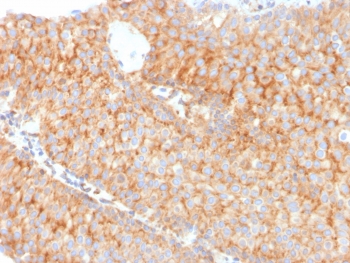SERBP1 Antibody Urothelial Carcinoma IHC. Immunohistochemistry analysis of FFPE human urothelial carcinoma tissue stained with SERBP1 Antibody demonstrates diffuse cytoplasmic HRP-DAB brown staining throughout malignant epithelial cell populations, consistent with SERBP1-associated RNA regulatory and translational control pathway expression. This mRNA binding protein antibody highlights post-transcriptional signaling and stress-response-associated cellular regulation within urothelial tumor tissue. Required HIER: boil tissue sections in pH 9 10mM Tris with 1mM EDTA for 10-20 min followed by cooling at RT for 20 min.
