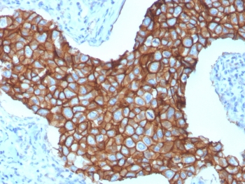 HER2 Antibody Breast Cancer IHC. Immunohistochemistry analysis of FFPE human breast carcinoma tissue using HER2 Antibody (clone ERBB2/3257) demonstrates strong HRP-DAB brown membranous staining outlining tumor epithelial cells, consistent with ErbB2 / HER2 overexpression as a receptor tyrosine kinase in breast cancer, while surrounding stromal tissue shows minimal signal; nuclei are counterstained blue. HIER: boil tissue sections in pH 6 10 mM citrate buffer for 10-20 min and allow to cool before testing.