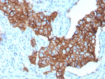 HER2 Antibody Breast Tumor Membrane IHC. Immunohistochemistry analysis of FFPE human breast carcinoma tissue using HER2 Antibody (clone ERBB2/3257) highlights intense, continuous HRP-DAB brown membranous staining across tumor cell clusters, emphasizing cell surface localization of ErbB2 / HER2 as a receptor tyrosine kinase, while adjacent stromal regions remain largely negative; nuclei are counterstained blue. HIER: boil tissue sections in pH 6 10 mM citrate buffer for 10-20 min and allow to cool before testing.