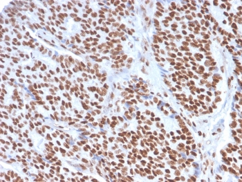 Estrogen Receptor alpha Antibody Breast Carcinoma IHC. Immunohistochemistry of FFPE human breast carcinoma tissue using Estrogen Receptor alpha antibody shows strong HRP-DAB brown nuclear staining in tumor epithelial cells, consistent with ESR1 expression in hormone-responsive breast cancer, while surrounding stromal cells display minimal background; detection was performed with clone ESR1/3557. HIER: boil tissue sections in pH 9 10mM Tris with 1mM EDTA for 10-20 min and allow to cool before testing.