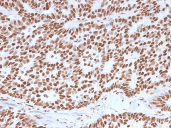 Estrogen Receptor alpha Antibody Human Breast Carcinoma Tissue IHC. Immunohistochemistry of FFPE human breast carcinoma tissue using Estrogen Receptor alpha antibody demonstrates strong HRP-DAB brown nuclear staining in tumor epithelial cells, consistent with ESR1 expression in hormone-responsive breast cancer, while surrounding stromal cells show minimal background; detection was performed with clone ESR1/3557. HIER: boil tissue sections in pH 9 10mM Tris with 1mM EDTA for 10-20 min and allow to cool before testing.