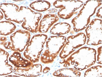 IHC staining of FFPE human renal cell carcinoma with biotinylated CD137 antibody (clone 4-1BB/3201). HIER: boil tissue sections in pH9 10mM Tris with 1mM EDTA for 10-20 min and allow to cool before testing.
