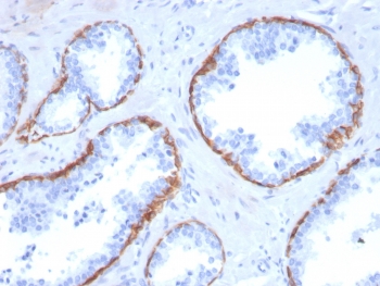 IHC staining of FFPE human prostate carcinoma with Cytokeratin 5 antibody (clone KRT5/3594). HIER: boil tissue sections in pH6, 10mM citrate buffer, for 10-20 min and allow to cool before testing.