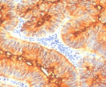 Immunohistochemistry analysis of Mucin 4 / MUC4 antibody (clone MUCN4-1) in human colon carcinoma tissue. FFPE human colon carcinoma section shows strong membranous and apical cytoplasmic brown chromogenic staining in malignant epithelial cells forming glandular structures, consistent with MUC4 expression, while surrounding stromal cells show minimal staining and nuclei appear blue. Heat-induced epitope retrieval was performed by steaming tissue sections in pH 9 10 mM Tris with 1 mM EDTA for 10-20 minutes followed by cooling prior to staining.