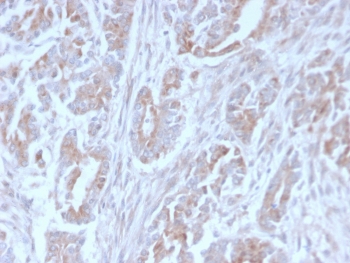 ICOSL Antibody Colon Carcinoma IHC. Immunohistochemistry analysis of FFPE human colon carcinoma tissue stained with clone ICOSL/3111. Tumor epithelial cells demonstrate membranous and cytoplasmic HRP-DAB brown staining consistent with expression of Inducible T-cell costimulator ligand / ICOSLG, an immune checkpoint-associated B7 family ligand involved in adaptive immune regulation and T-cell costimulation signaling within the tumor microenvironment. Stromal connective tissue shows comparatively reduced staining intensity. HIER: boil tissue sections in pH 9 10mM Tris with 1mM EDTA for 10-20 min and allow to cool before testing.