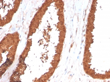 TIGIT Antibody Prostate Carcinoma IHC. Immunohistochemistry analysis of FFPE human prostate carcinoma tissue using TIGIT Antibody (clone TIGIT/3017) demonstrates HRP-DAB brown membranous and cytoplasmic staining in tumor-associated epithelial cells and infiltrating immune cells within the tumor microenvironment, consistent with TIGIT expression as an immune checkpoint marker involved in regulating local immune responses, while surrounding stromal elements show lower signal; nuclei are counterstained blue. HIER: boil tissue sections in pH 6 10 mM citrate buffer for 10-20 min and allow to cool before testing.