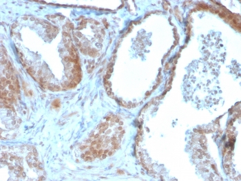 TIGIT Antibody Prostate Carcinoma IHC. Immunohistochemistry analysis of FFPE human prostate carcinoma tissue using TIGIT Antibody (clone TIGIT/3016) demonstrates HRP-DAB brown membranous and cytoplasmic staining in tumor-associated epithelial cells and infiltrating immune cells within the tumor microenvironment, consistent with TIGIT expression as a tumor immune microenvironment marker involved in immune checkpoint regulation, while surrounding stromal components show lower signal; nuclei are counterstained blue. HIER: boil tissue sections in pH 6 10 mM citrate buffer for 10-20 min and allow to cool before testing.
