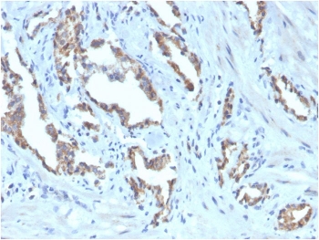 TIGIT Antibody Biotin Conjugate Human Prostate Carcinoma Tissue IHC. Immunohistochemistry staining of FFPE human prostate carcinoma with biotinylated TIGIT antibody. HIER: boil tissue sections in pH 9 10mM Tris with 1mM EDTA for 20 min and allow to cool before testing.