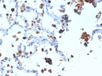 Napsin A Antibody for IHC. Immunohistochemistry analysis of Napsin A (NAPSA) expression in FFPE human lung adenocarcinoma demonstrates granular cytoplasmic HRP-DAB brown staining in tumor epithelial cells with minimal background in surrounding stromal regions. Clone NAPSA/3308 highlights pulmonary epithelial cell populations consistent with the role of Napsin A as a lung epithelial marker, supporting identification of epithelial lineage within tumor tissue. HIER was performed by boiling tissue sections in pH 9 10mM Tris with 1mM EDTA for 10-20 minutes followed by cooling at RT for 20 minutes prior to staining.