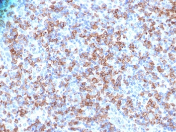CD8A Antibody Human Lymphoma IHC. Immunohistochemistry analysis of CD8 alpha (CD8A) in FFPE human lymphoma tissue shows strong membranous staining of cytotoxic T lymphocytes within the tumor microenvironment, consistent with CD8-positive cells functioning as effector T cells involved in target cell recognition and elimination. Heat-induced epitope retrieval was performed in pH 9 10 mM Tris with 1 mM EDTA for 10-20 minutes followed by cooling at room temperature.