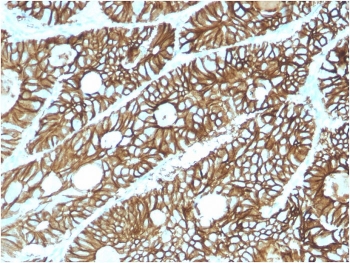 Cadherin 17 Antibody Colon IHC. Immunohistochemistry staining of FFPE human colon tissue using Cadherin 17 Antibody / Liver-Intestine Cadherin Antibody (clone CDH17/2615) demonstrates strong membranous HRP-DAB brown staining throughout colonic epithelial cells lining glandular and crypt structures. The staining pattern is consistent with expression of CDH17 (LI-cadherin), a calcium-dependent cell adhesion molecule that contributes to epithelial organization, maintenance of tissue integrity, and regulation of cell-cell interactions within the gastrointestinal tract. CDH17 is highly expressed in intestinal epithelium and serves as a well-established marker of gastrointestinal epithelial differentiation and lineage. HIER was performed by boiling tissue sections in pH 9, 10 mM Tris with 1 mM EDTA for 10-20 minutes followed by cooling prior to immunostaining.