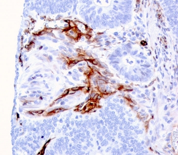 IHC staining of FFPE human colon carcinoma with Nestin antibody (clone NES/2911). HIER: boil tissue sections in pH 9 10mM Tris with 1mM EDTA for 10-20 min and allow to cool before testing.