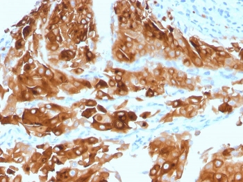 Immunohistochemistry of UPK1A antibody in human urothelial carcinoma. Formalin-fixed, paraffin-embedded human urothelial carcinoma tissue was stained with microarray validated Uroplakin 1A antibody (clone UPK1A/2921) following heat-induced epitope retrieval by boiling in pH 9 10 mM Tris with 1 mM EDTA for 10-20 minutes and cooling prior to testing. HRP-DAB brown chromogenic signal demonstrates strong membranous and cytoplasmic staining in malignant urothelial cells, consistent with urothelial differentiation and the characteristic apical membrane-associated expression pattern of Uroplakin 1A, while surrounding stromal elements remain largely negative.