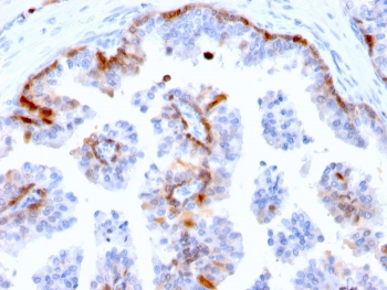 Cystatin A Antibody Prostate Immunohistochemistry. IHC staining of FFPE human prostate with Cystatin A antibody (clone CSTA/2882). HIER: boil tissue sections in pH 9 10mM Tris with 1mM EDTA for 10-20 min and allow to cool before testing.