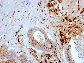 Cathepsin D Antibody Liver Carcinoma IHC. Immunohistochemistry analysis of FFPE human liver carcinoma tissue using Cathepsin D antibody (clone CTSD/3082) shows strong granular cytoplasmic staining in tumor cells and prominent signal in infiltrating macrophages, consistent with CTSD / Cathepsin D localization in lysosomal compartments. The punctate staining pattern reflects lysosomal protease activity associated with intracellular protein degradation and tumor-associated macrophage function. Tumor architecture is preserved, and hematoxylin counterstain provides nuclear contrast and structural context. HIER: boil FFPE tissue sections in pH 9 10 mM Tris with 1 mM EDTA for 10-20 min and allow to cool before testing.