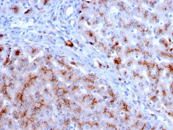 Cathepsin D Antibody FFPE Liver IHC Analysis. Immunohistochemistry staining of FFPE human liver with Cathepsin D antibody (clone CTSD/3083). HIER: boil tissue sections in pH 9 10mM Tris with 1mM EDTA for 10-20 min and allow to cool before testing.